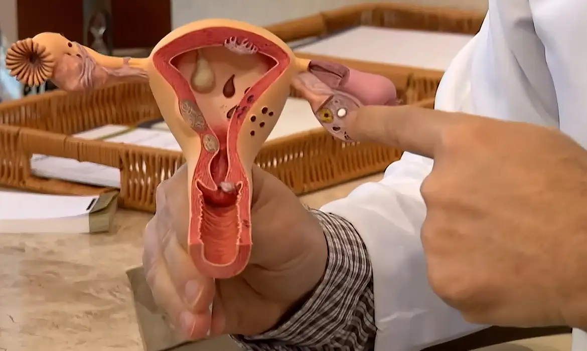 Foto Planos de saúde terão de cobrir DIU hormonal para casos de endometriose