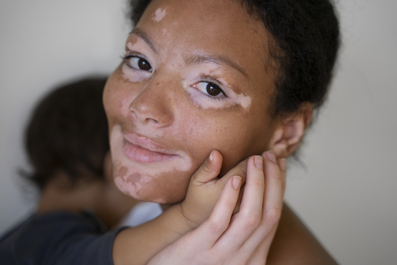 Mulher com rosto coberto por manchas do vitiligo