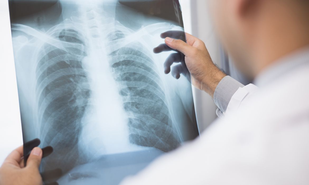 Foto Anvisa aprova novo medicamento para câncer de pulmão avançado
