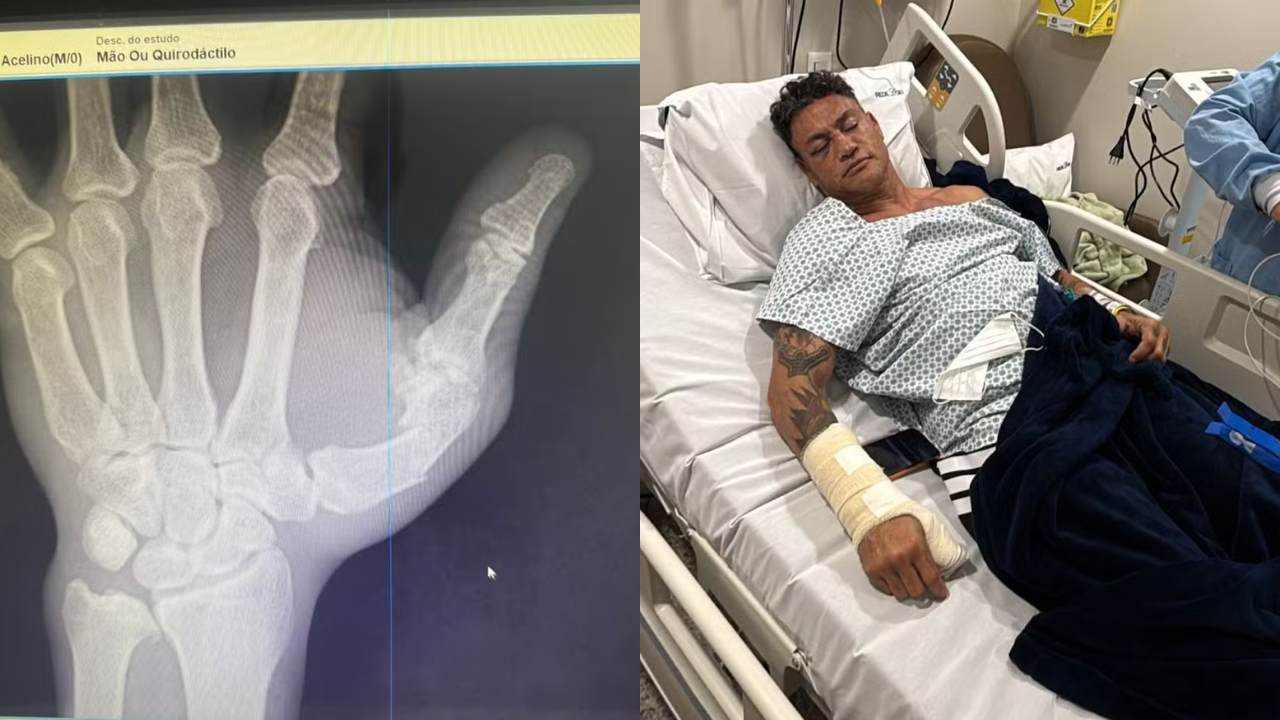 popó quebrou o mão